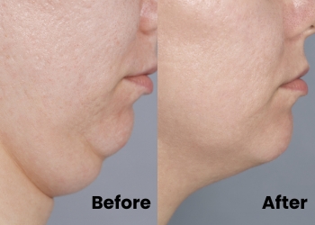 Endolift